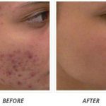 Acne-Results