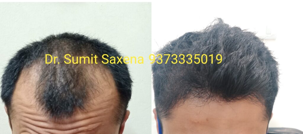 Hair Transplant in Bangalore Best Surgeon  Affordable Cost