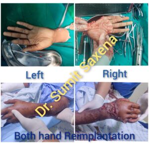 Bilateral Reimplant Hands